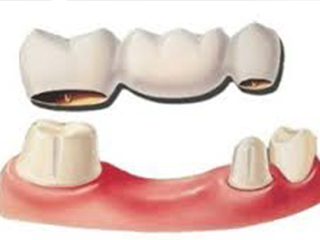 Dentures Marietta, GA - Happy Dental and Orthodontics - Types of Dentures